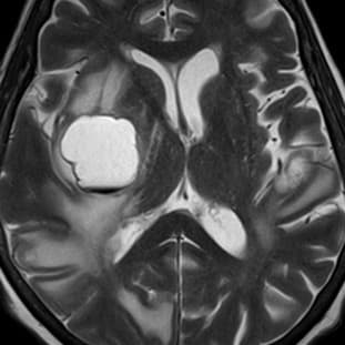 Brain Metastases