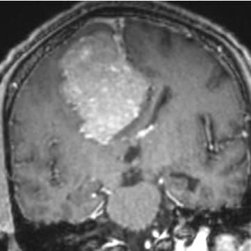 Meningioma